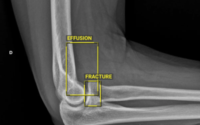 Sectra deploys AI to improve fracture detection in Northern Ireland