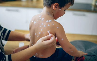 Chickenpox danger warning as parents urged to look out for early symptoms in children